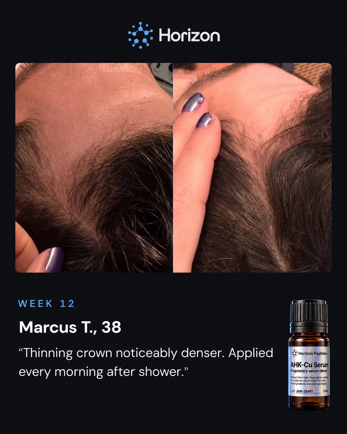 AHK-CU | HAIRLINE REGROWTH KIT
