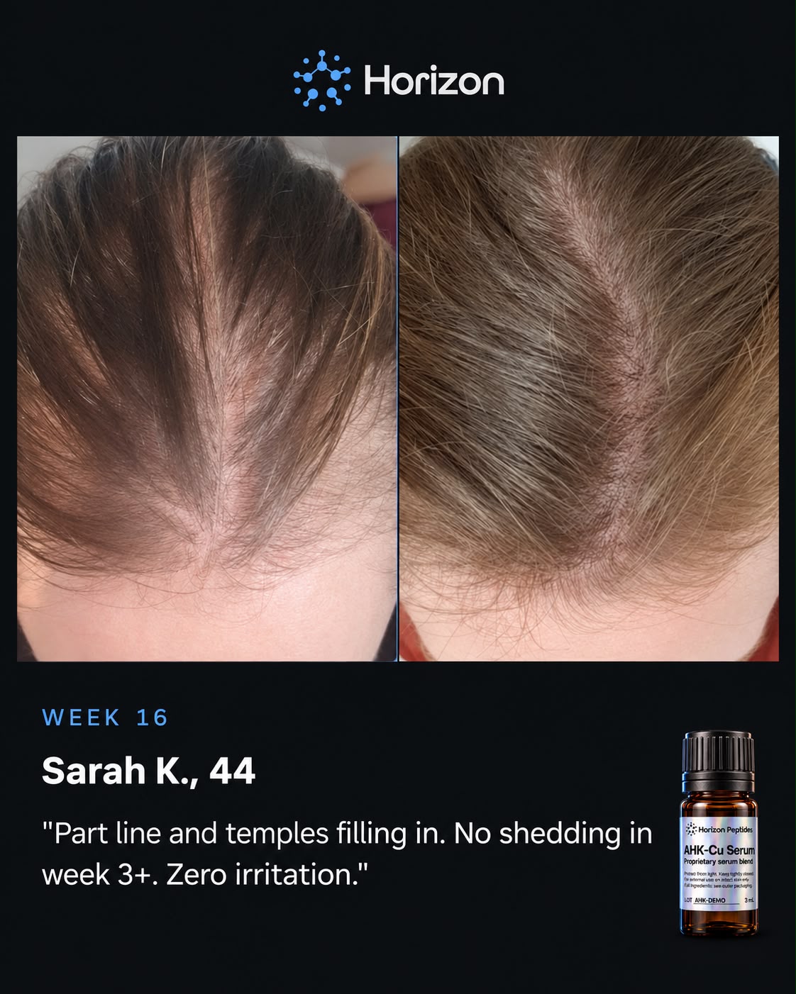 AHK-CU | HAIRLINE REGROWTH KIT