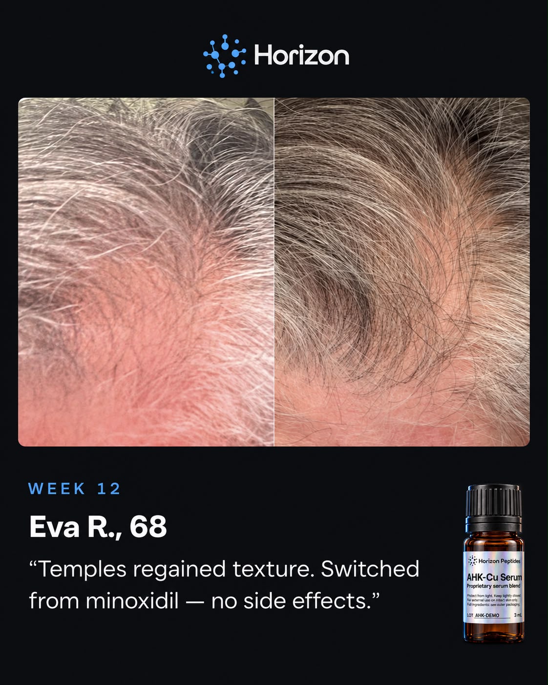 AHK-CU | HAIRLINE REGROWTH KIT
